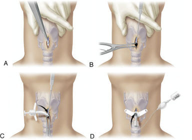 How is a laryngotomy carried out?