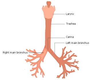 Why is an inhaled objected more likely to enter the right bronchus than the left bronchus?