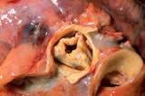 5.2 FORMACIÓN DEL SENO PULMONAR A LA DERECHA DE LA AURÍCULA.