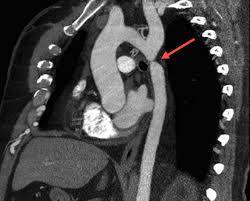 5.7 COARTACIÓN DE AORTA