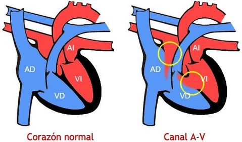 Mientras que el septum primum se funde con las almohadillas endocráticas, y cierra el foramen primum, la parte superior del septum se rom...