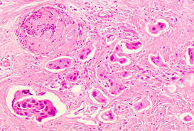 La variante histológica más frecuente del cáncer de mama es