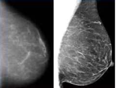 ¿Cuál es el método actualmente más eficaz y recomendado para el cribado del cáncer de mama("screening" o detección precoz), en mujeres as...