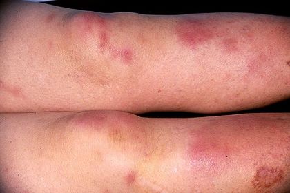 Los pacientes con enfermedad inflamatoria intestinal presentan frecuentemente diversas manifestaciones extra-intestinales. Algunas de ell...
