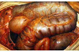 Un paciente con antecedentes de colitis ulcerosa estable, acude a Urgencias por fiebre, diarrea intensa con rectorragia y dolor abdominal...