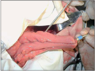 Una mujer de 55 años diagnosticada de proctocolitis ulcerosa (con pancolitis) hace 17 años. En la última Colonoscopia realizada de revisi...