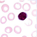 Anemia normocítica normocrómica Se caracteriza por presentar eritrocitos de tamaño y color normal; puede ocurrir por una disminución de s...