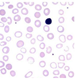 Anemia macrocítica sin megaloblastos Se caracteriza por macrocitos redondos, el recuento de plaquetas y leucocitos es normal, además en m...