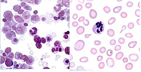 Anemia macrocítica con megaloblastos Se caracteriza por la presencia de megaloblastos, punteado basófilo, anillos de Cabot, cuerpos de Ho...
