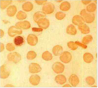 Hemoglobinopatía C Se caracteriza por una anemia normocítica normocrómica y puede haber cierto grado de macrocitosis e hipocromía leve. E...