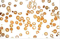 Hemoglobinopatía E Se presenta como una anemia leve con microcitosis y células blanco. Los individuos son sanos y se asocia con β- talase...