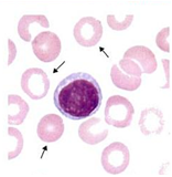 α - Talasemia Puede ser causado por la forma homocigota (-α/-α) o heterocigota (--/αα), y en frote sanguíneo se muestra una anemia leve c...