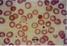 β+ talasemia o talasemia menor Se caracteriza por ausencia de cadenas de globina, anemia de leve a moderada y reticulocitos ligeramente a...
