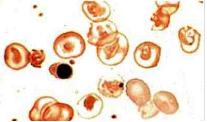 βo talasemia o talasemia mayor En ella hay ausencia de cadenas de globina, anemia hemolítica y en frote periférico se observa anisocitosi...