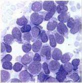 Leucemia mieloblástica aguda mínimamente diferenciada (M0) Blastos agranulares de mediano tamaño, cromatina dispersa, núcleo redondo o li...