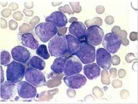 Leucemia mieloblástica aguda sin maduración (M1) Diferenciación mínima. Mieloblastos son más del 30% con relación M:E mayor que 1; Prueba...