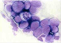 Leucemia mieloblástica aguda con maduración (M2) Se caracteriza por 90% blastos y un 10% se encuentra más allá del estadío de promielocit...