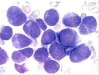 Leucemia promielocítica aguda (M3) hipergranular Presenta más del 30% mieloblastos, posee promielocitos anormales con gránulos muy abunda...