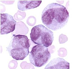 Leucemia promielocítica aguda (M3) microganular Presenta gránulos más pequeños, con núcleos reniformes o bilobulados. Prueba positiva par...