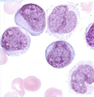 Leucemia mielomonocítica aguda (M4) Se caracteriza por células malignas granulocíticas y monocíticas; más del 20% es de origen monocítico...