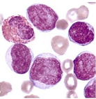 Leucemia mielomonocítica aguda (M4) con eosinofilia En sangre periférica se observa mieloblastos y otras células mieloides inmaduras, así...