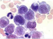 Leucemia monocítica aguda (M5) tipo A Mal diferenciada y más del 80% son monoblastos; poseen cromatina delicada, nucleólos destacados y c...