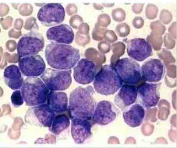 Leucemia monocítica aguda (M5) tipo B Menos del 80% son monoblastos, predominan monocitos y promonocitos con núcleos cerebriformes grande...