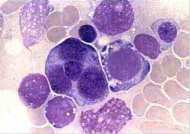 Eritroleucemia aguda (M6) Única leucemia mieloide aguda con hiperplasia de precursores eritroides. Más el 50% de las células en médula ós...
