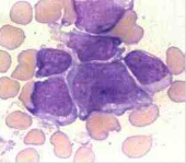 Leucemia megacariocítica aguda (M7) Presencia de 30% de blastos en la médula (30% de estos son megacarioblastos) y el tamaño de megacario...