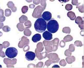 Leucemia linfoide aguda tipo 1 Presenta linfoblasto pequeño, citoplasma azul escaso con núcleo redondo, los nucleólos son indistinguibles...