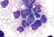 Leucemia linfoide aguda tipo 2 Muestra de 2 a 3 veces el tamaño del linfocito, el citoplasma es moderado y la membrana nuclear es irregul...