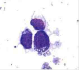 Leucemia linfoide aguda tipo 3 Blasto muy grande, 3-5 nucleolos, citoplasma azul oscuro y vacuolas citoplásmicas (Rodak, 2004).