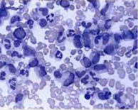 Leucemia mieloide crónica Se caracteriza por panmielosis con predominio del componente mieloide en médula ósea, sangre periférica y otros...
