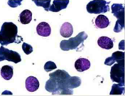 Leucemia de células pilosas Tipo de leucemia linfoide crónica en donde las células pilosas son linfocitos B; muestran núcleos reniformes ...