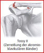 Tossy II