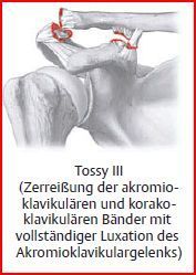 Tossy III