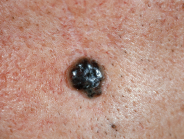 Pigmentiertes Basaliom