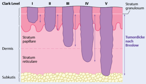 Tumoreindringtiefen der Melanome: Breslow (mm) und Clark (Level I–IV)
