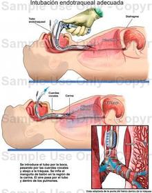 INTUBACIÓN ENDOTRAQUIAL