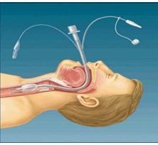 PRECAUCIONES -Valorar función respiratoria del paciente -explicar el procedimiento al paciente -procedimiento invasivo estéril -equipo de...