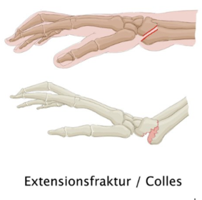 Wie sieht die Extensionsfraktur aus?