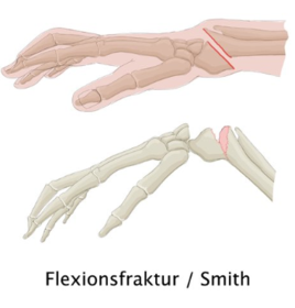 Wie sieht die Flexionsfraktur aus?
