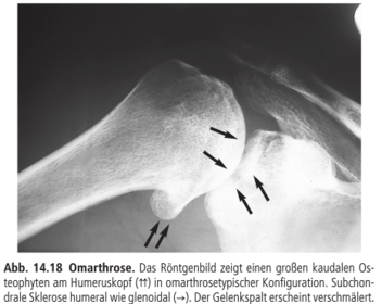 Wie sieht eine Omarthrose im Röntgen aus?