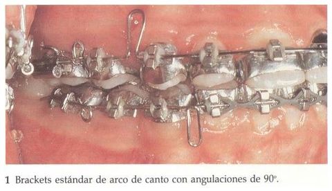 Mecánica en el Tratamiento de Ortodoncia y la Aparatología de Arco Recto
