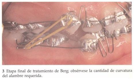 Se introdujeron otras técnicas ortodóncicas: por ejemplo, el sistema de Begg, creado en Adelaida, Australia, que fue muy utilizado durant...