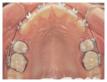 En muchos casos, es útil doblar los extremos de estos alambres en pequeños círculos inmediatamente dístales al tubo molar (sobre todo en ...