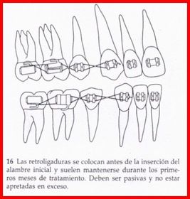 LAZOS DE RETRACCIÓN DE LOS CANINOS Se construyen con alambre de ligadura de 0,009 a 0,010 son eficaces para controlar los caninos durante...