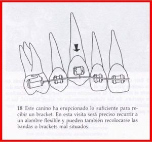 COLOCACIÓN DE BRACKETS Y BANDAS El aparato Straigh-Wire constituye un sistema refinado y preciso, precisión que debe también acompañar a ...