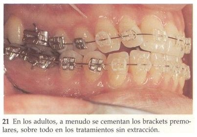 BANDAS Y CEMENTADOS