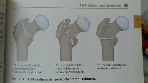 Untere Extremität: Frakturen